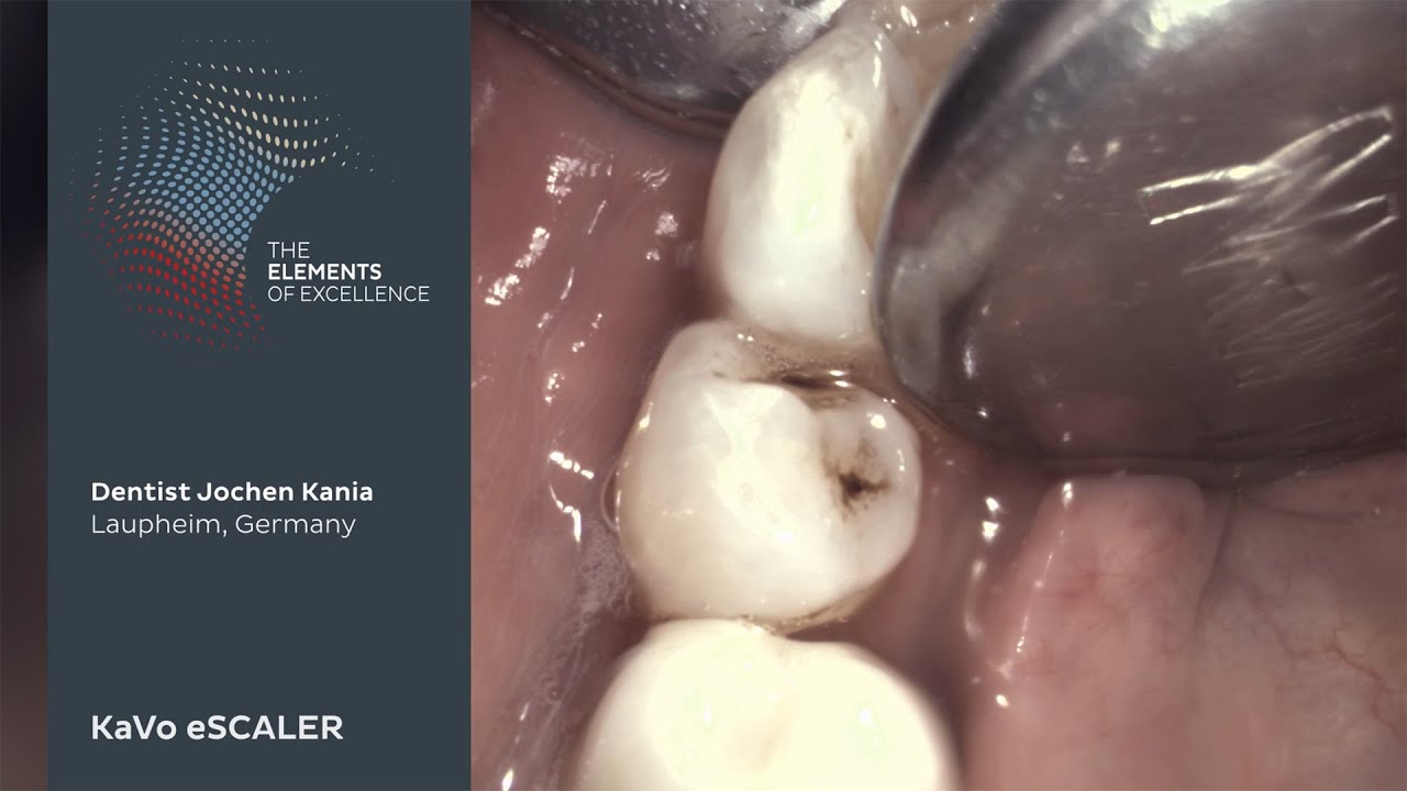 Calculus removal with the KaVo eSCALER