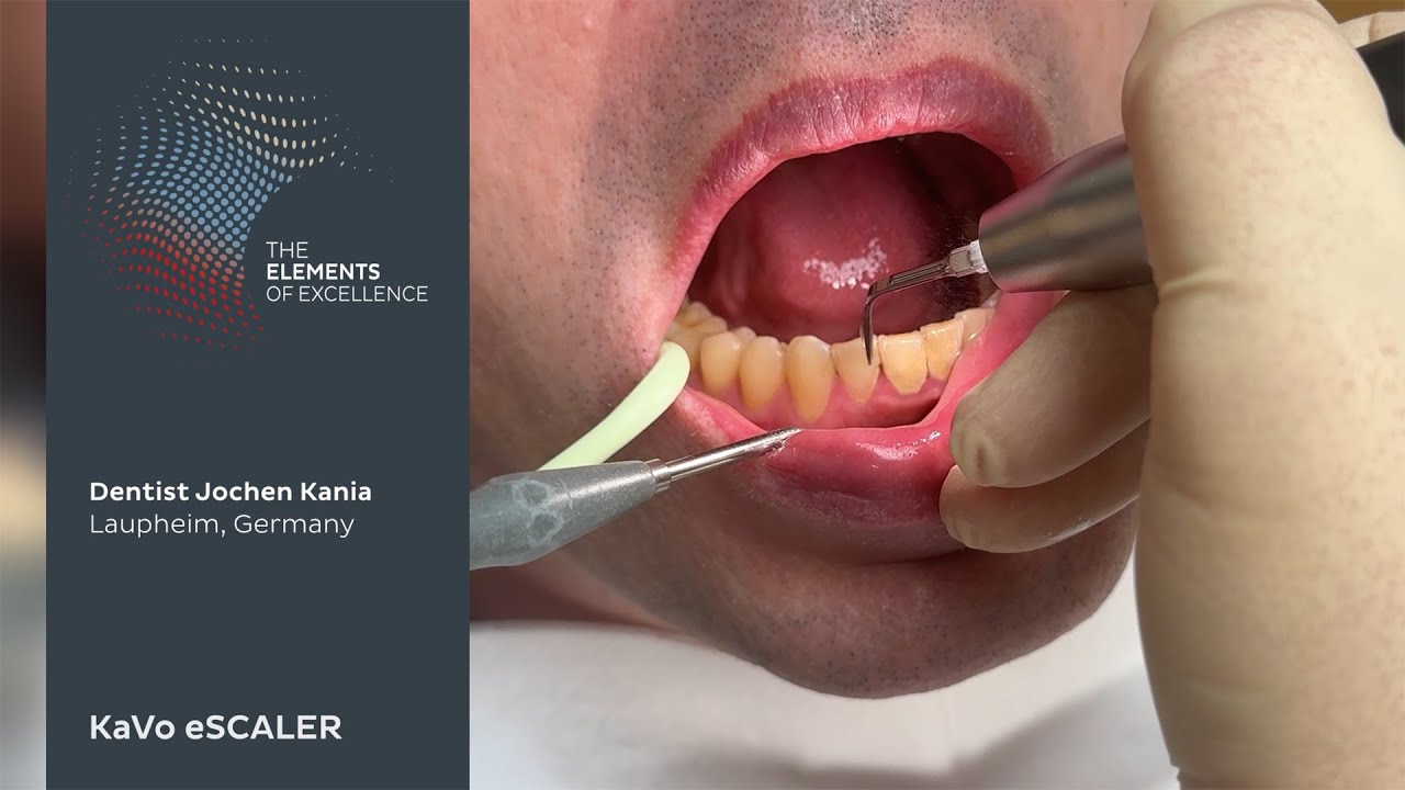 Calculus removal with the KaVo eSCALER