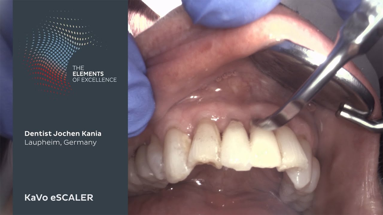 Calculus removal with the KaVo eSCALER.